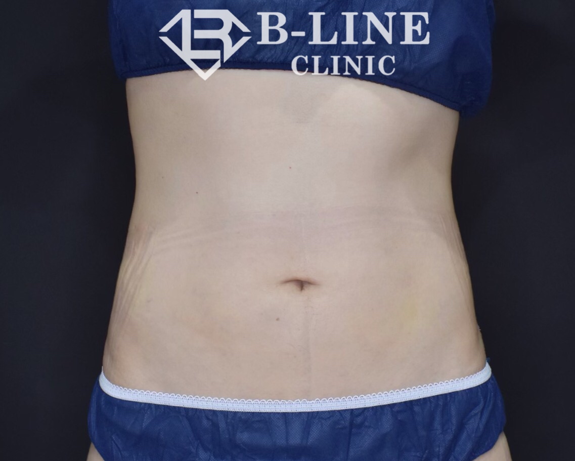 【40代男性・腹部上下】ベイザー脂肪吸引（1ヶ月後） - 症例写真 - 美容整形、美容外科なら聖心美容クリニック