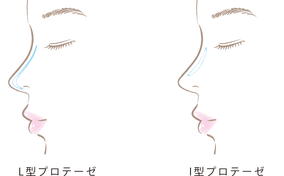 隆鼻術（プロテーゼ）イメージ