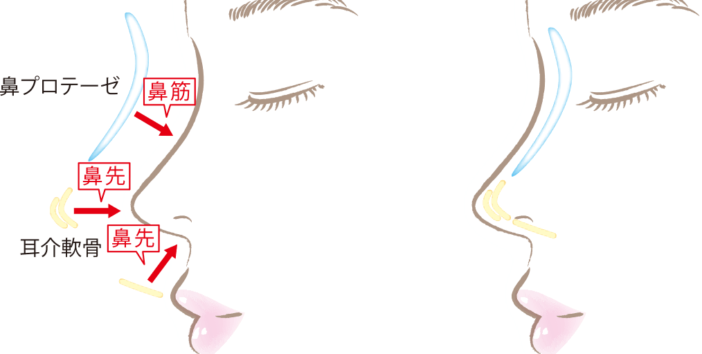 隆鼻術（プロテーゼ）イメージ