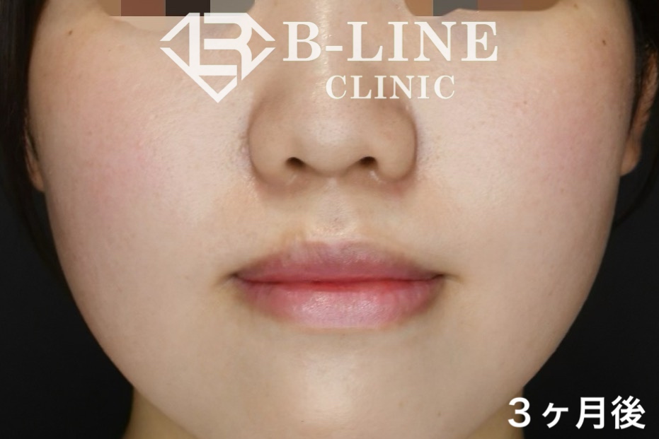 口唇縮小術 | 池袋のB-LINE CLINIC